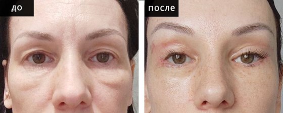 Эндоскопическая подтяжка височной зоны лица. Зиятдинов 01: до и после – фото 3